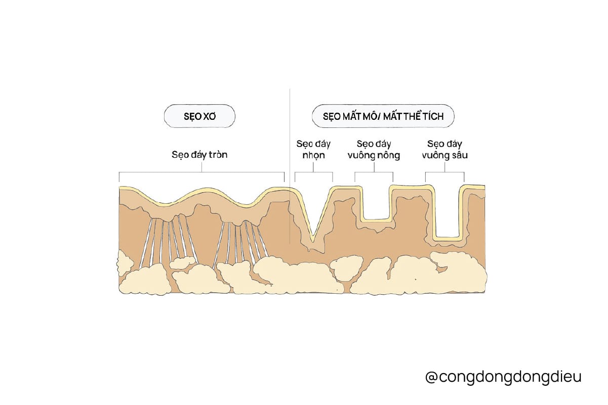 Sẹo rỗ từ A đến Z và công nghệ mới trị sẹo rỗ không đau?