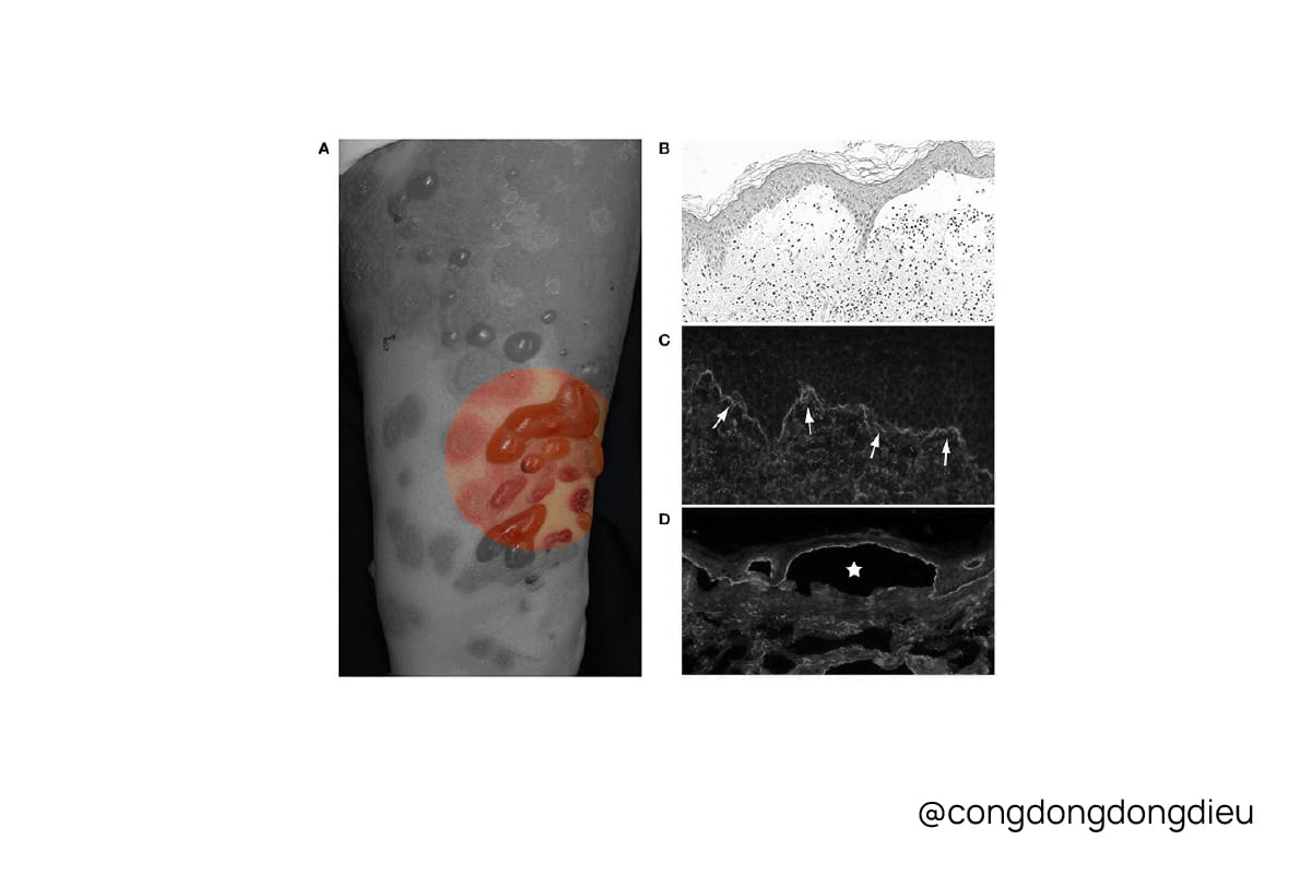 Bệnh bóng nước Pemphigoid