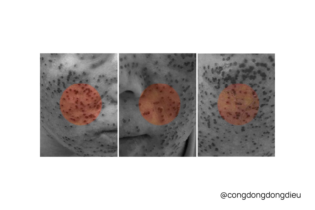 Herpes dạng chàm - Eczema herpeticum