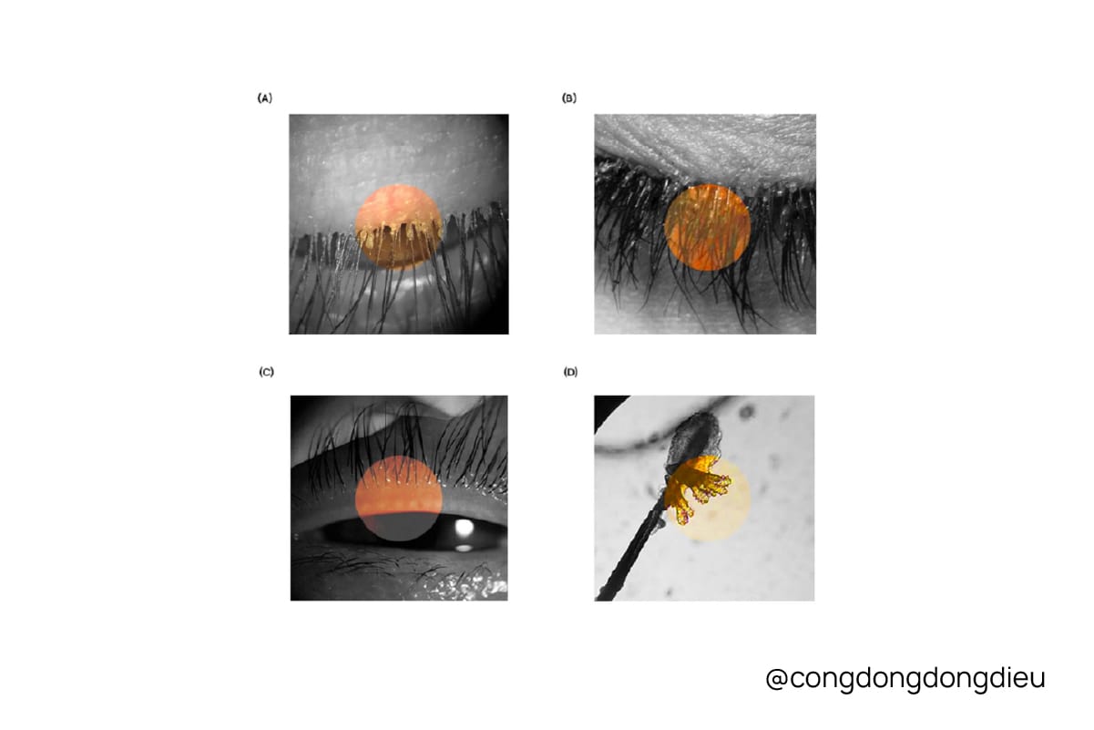 Ocular demodicosis - Viêm bờ mi do ve Demodex