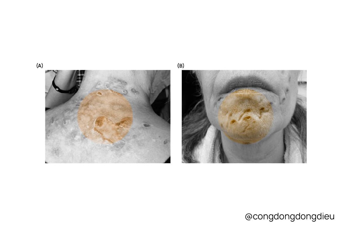 Bệnh Morgellons