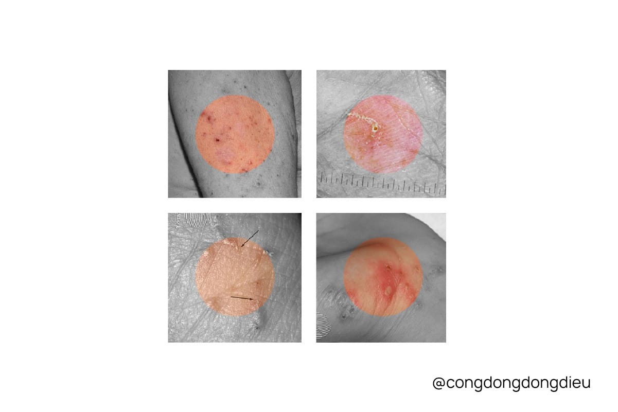 Bệnh ghẻ (scabies)