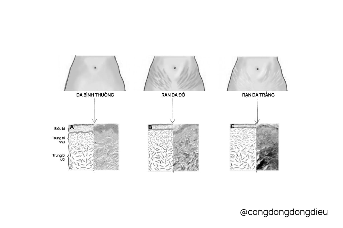 Rạn da từ A đến Z và công nghệ xóa rạn bằng khí