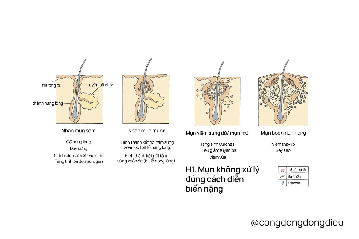 Trị mụn “tự thân” có thật hay không?