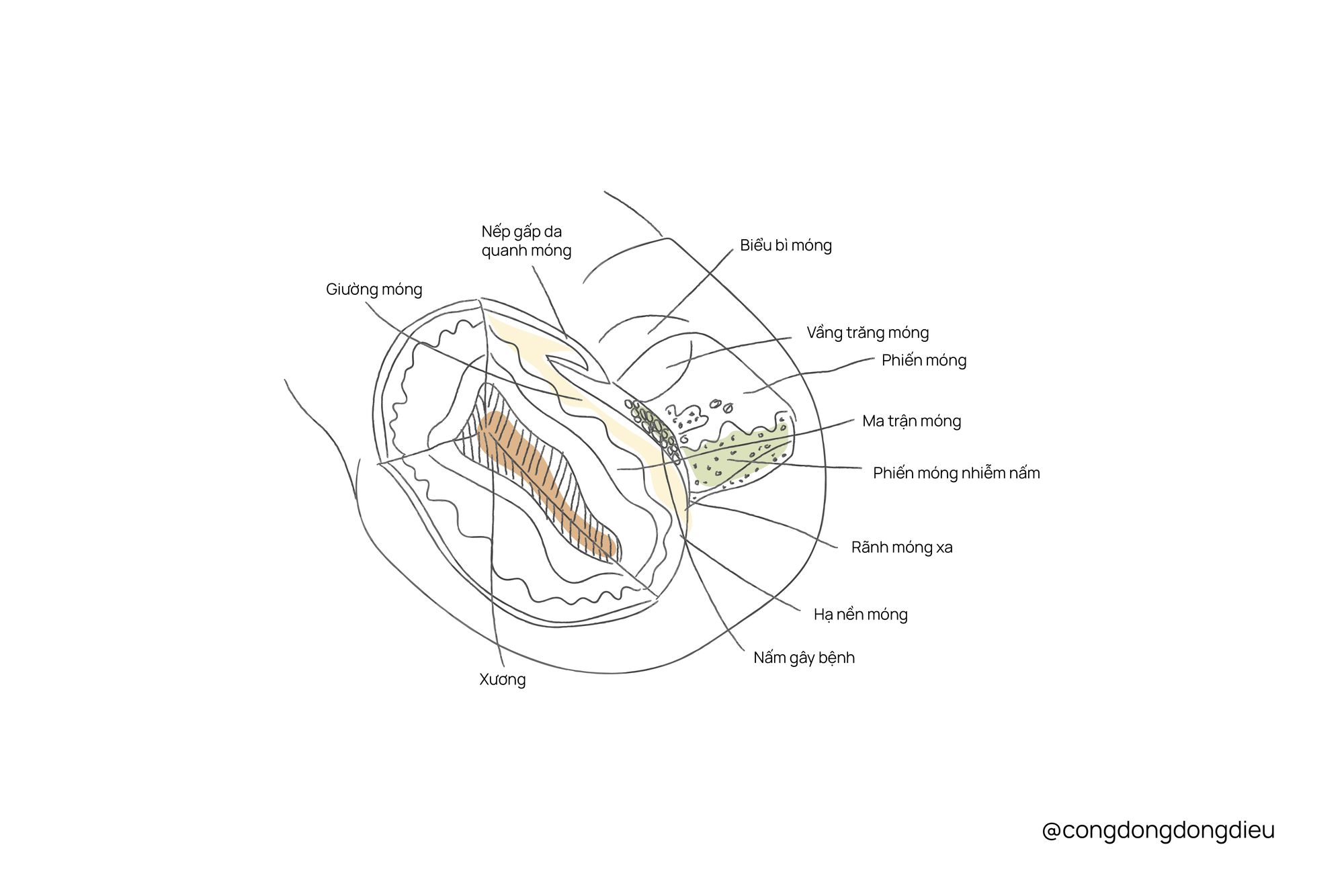 Bệnh nấm móng nông trắng (White Superficial Onychomycosis - WSO)