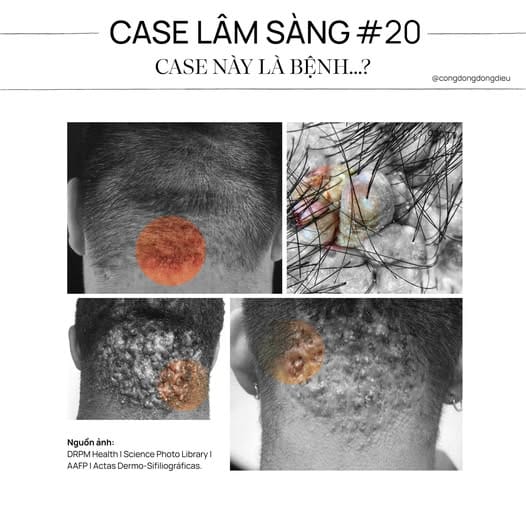 Bệnh viêm nang lông sẹo lồi (tên tiếng Anh: folliculitis keloidalis - FKN)