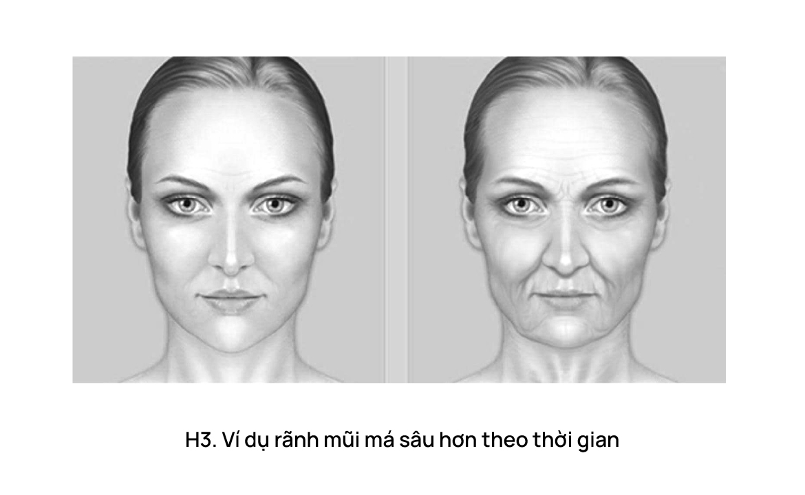 Những vùng tiêm filler có thể gây chảy xệ khuôn mặt