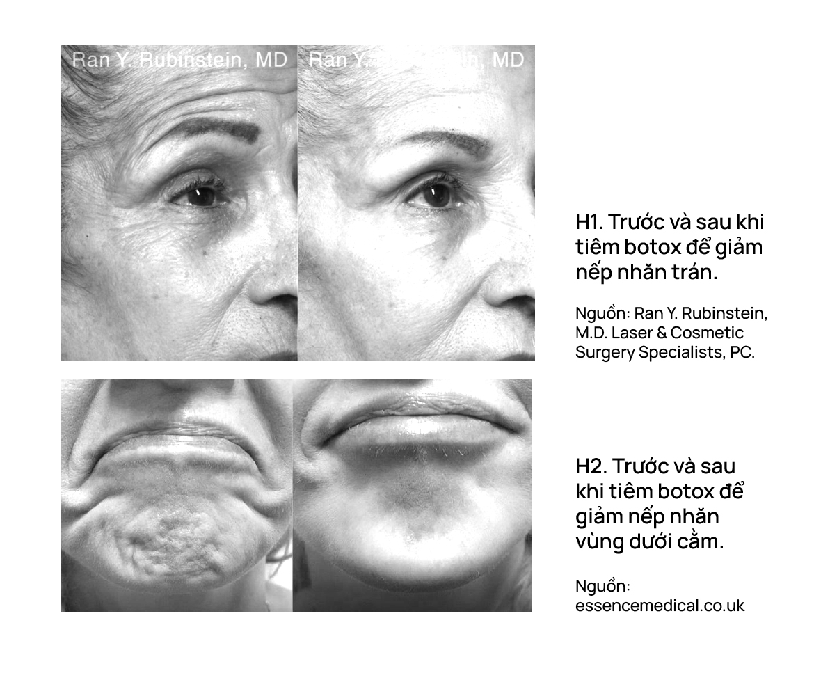 Những điều cần biết khi sử dụng botox (botulinum toxin)?