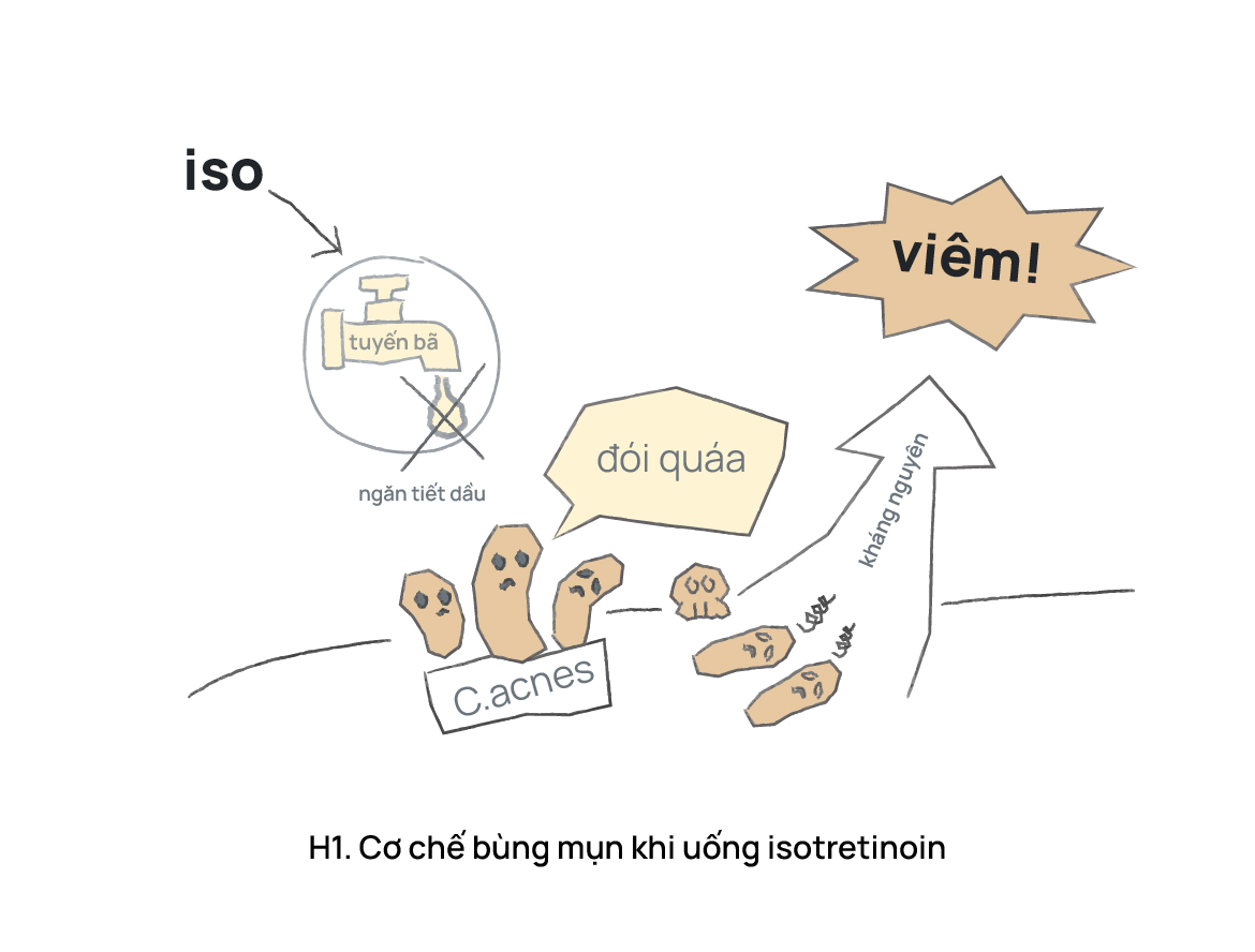 Bùng phát mụn sau isotretinoin và cách hạn chế bùng phát?