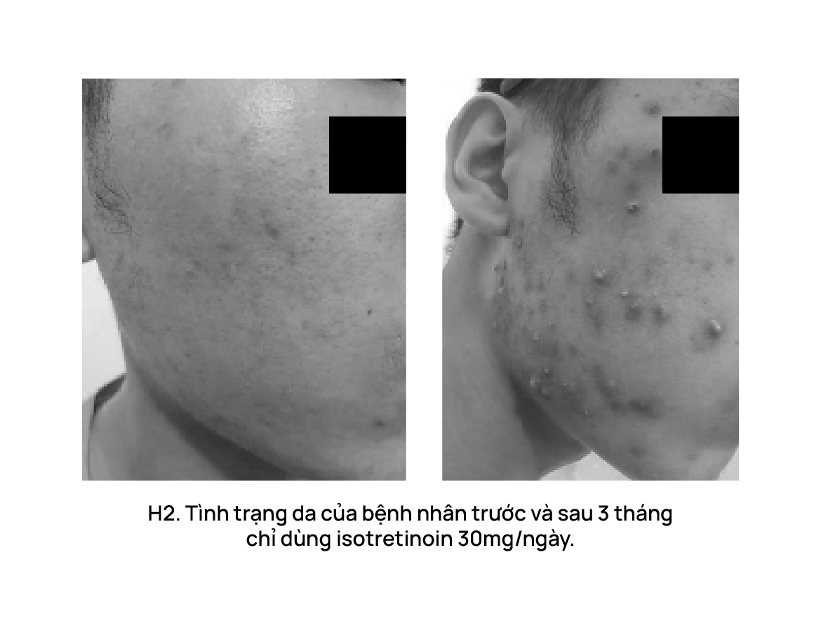 Bùng phát mụn sau isotretinoin và cách hạn chế bùng phát?