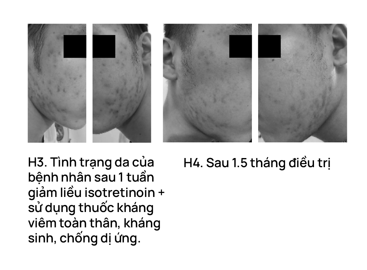 Bùng phát mụn sau isotretinoin và cách hạn chế bùng phát?