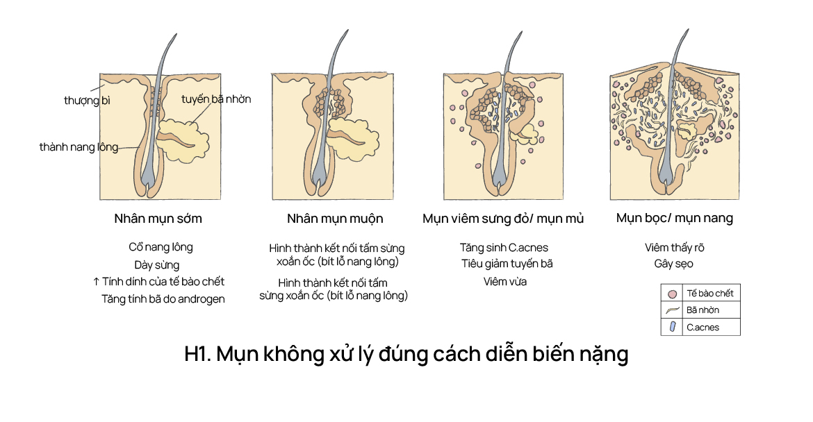 Mụn không được xử lý đúng cách diễn biến nặng