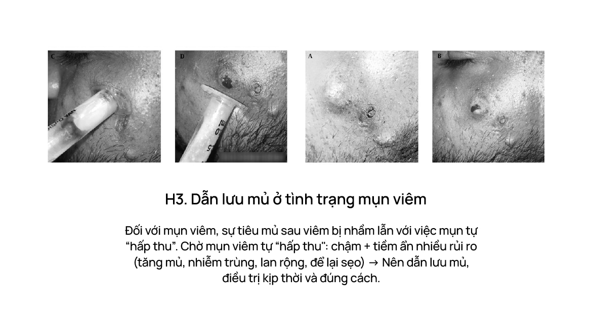 Dẫn lưu mủ ở tình trạng mụn viêm