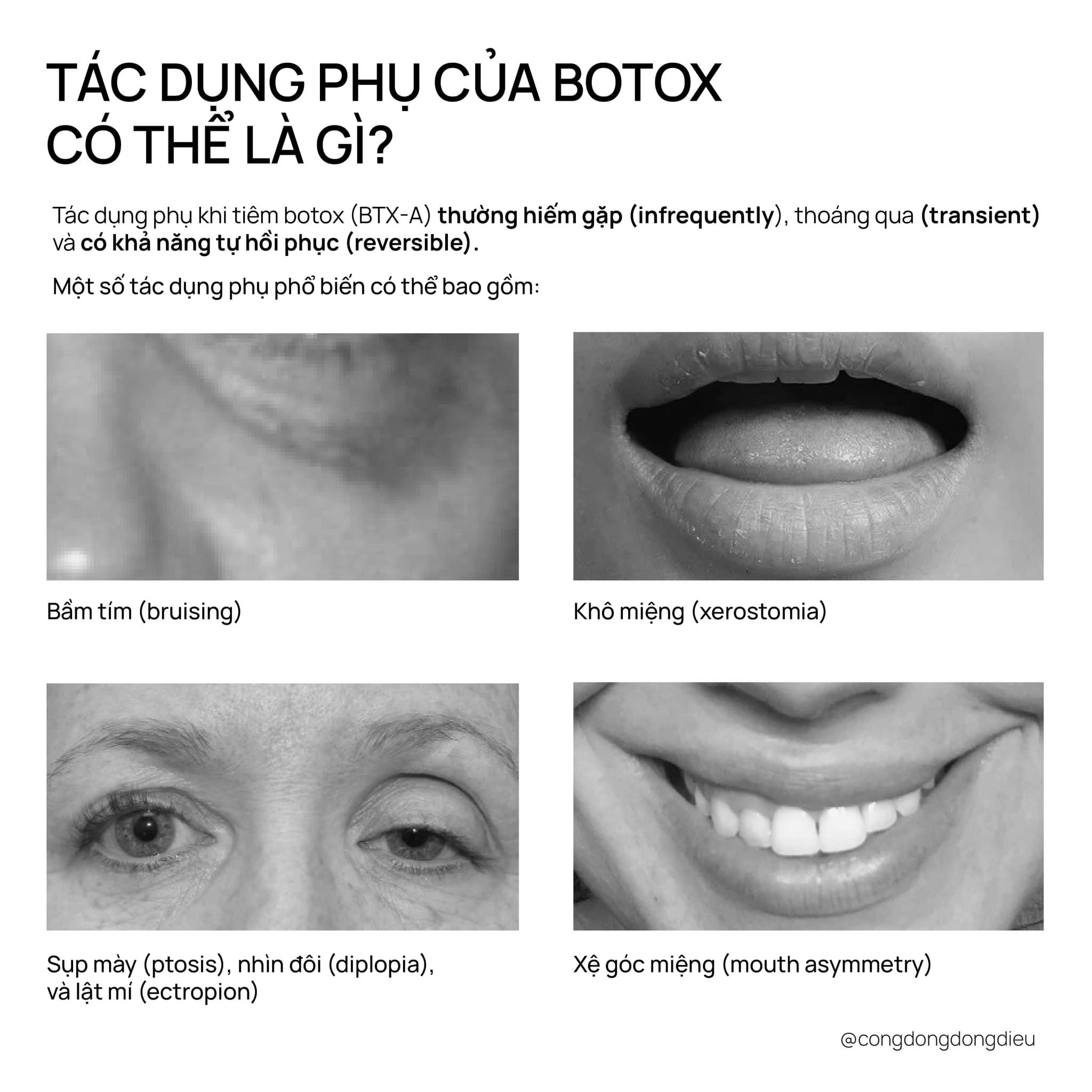 Đồng Điệu hỏi - Bác Phương trả lời: 10 câu hỏi về botox